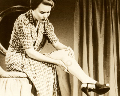 A woman sits on a stool and examines a blister on her left leg. 